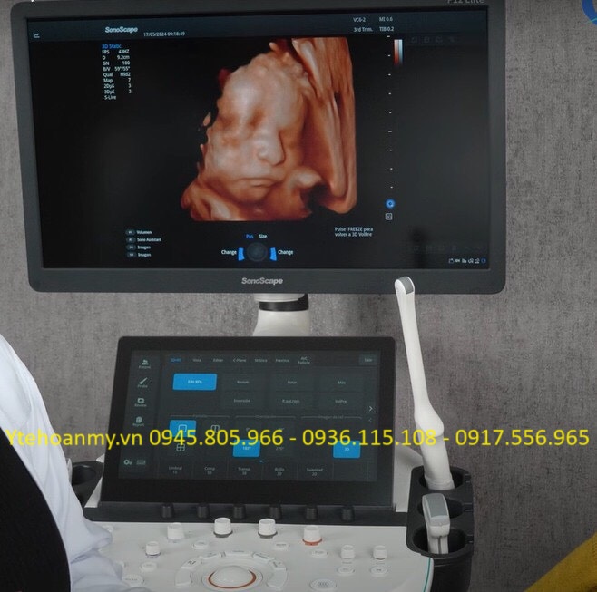 Máy Siêu Âm So Với MRI và CT: Lựa Chọn Nào Tốt Hơn?